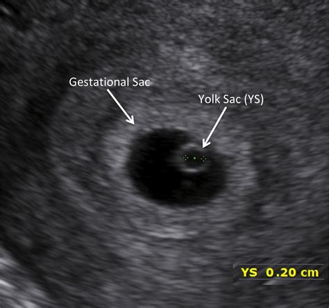 can an enlarged yolk sac correct itself|Early pregnancy ultrasound measurements and prediction of.